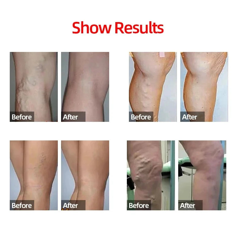 1 Pair Men’s Calf Sleeves – Compression Socks for Sports, Varicose Vein Relief & Running Support - Image 5